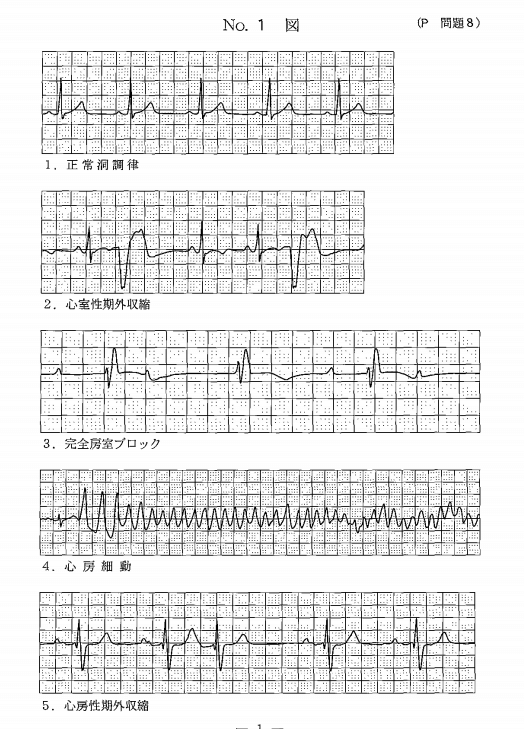 理学療法士国家試験 心電図について ステップ 異常な波形を覚える まとめ 解説 明日へブログ